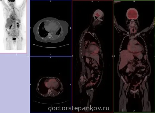 Maximum intensity projection image, axial, transverse and coronal fused PET/CT images show enhanced pericardial FDG uptake and thickening, demonstrating active TB pericarditis. Based on FDG PET/CT findings, this patient who had presented with heart failure was commenced on anti-tuberculous medication. Ejection fraction as well as features of systemic heamodynamic congestion improved subsequently.