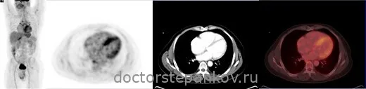 Maximum intensity projection and axial PET/CT image demonstrates markedly increased FDG uptake in the ventricular myocardium and mediastinal lymph nodes, in support of the diagnosed cardiac sarcoidosis. Patient‘s left ventricular function improved and arrhythmia resolved on steroid therapy.
